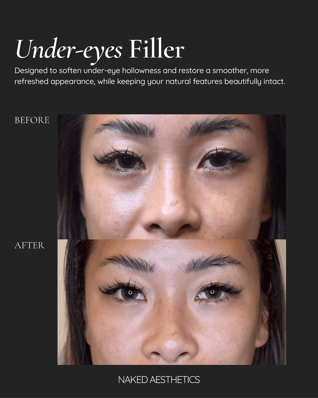 Under-Eye Filler Treatments Restore Volume and Radiance