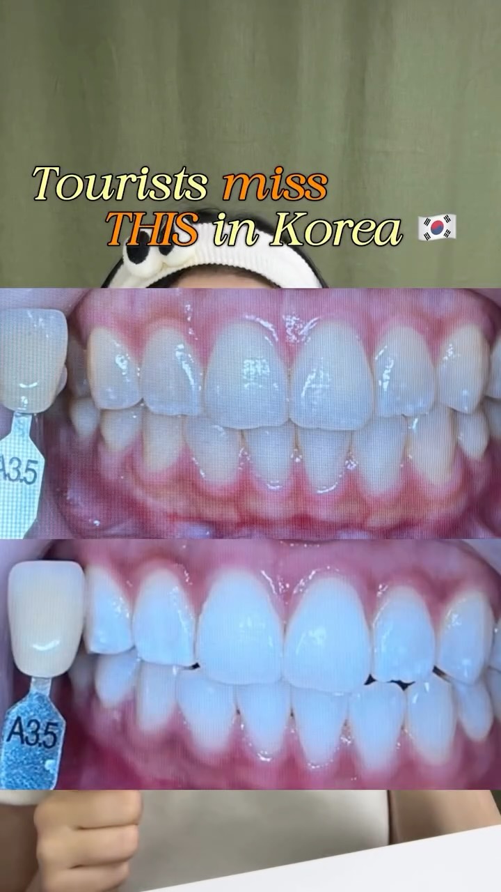 Seoul's Sinsa-dong: Teeth Whitening Destinations