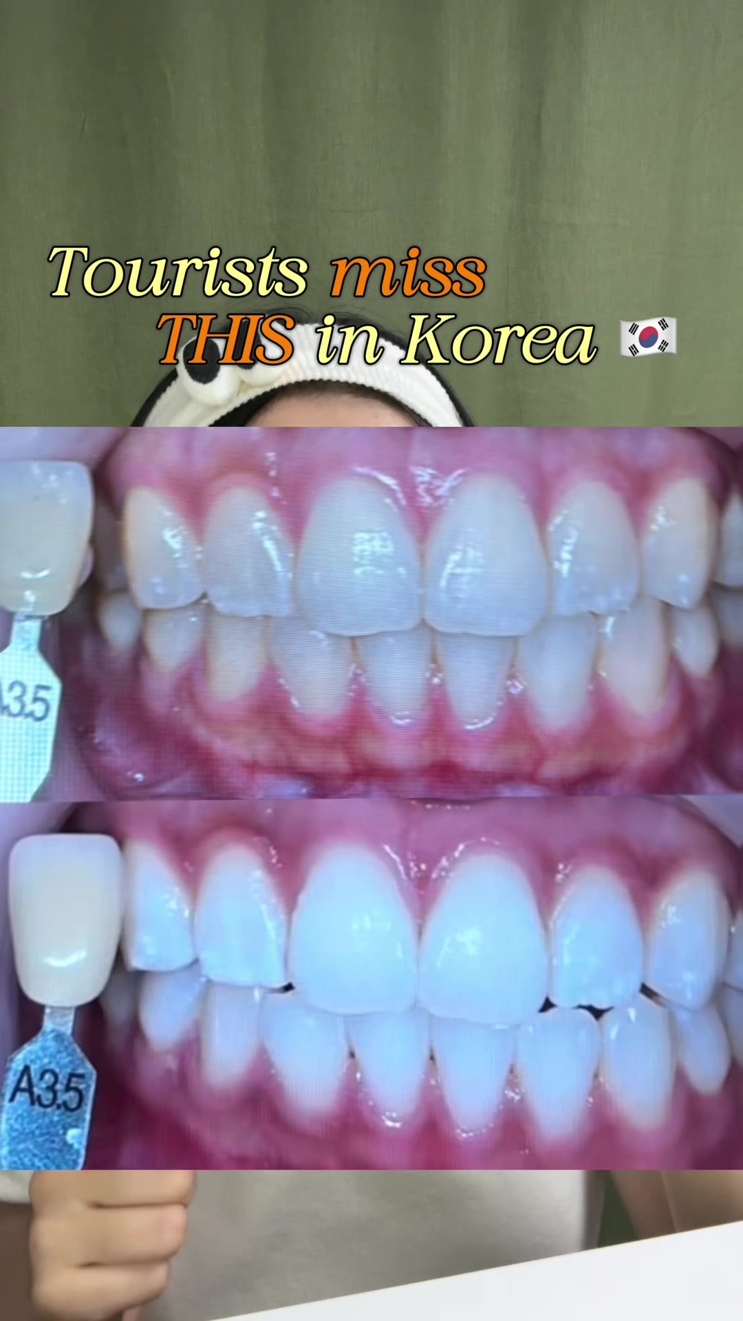 Teeth Whitening Options in Sinsa Station