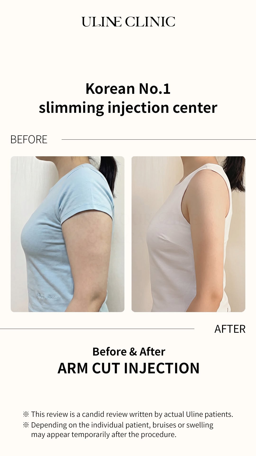 U Line Clinic Offers Upper Arm Slimming Treatments