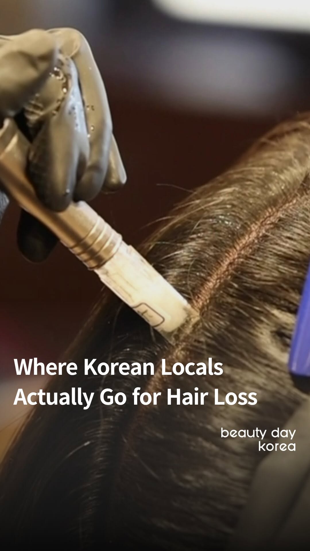 Korean Hair Loss Clinics Offer Medical Treatments