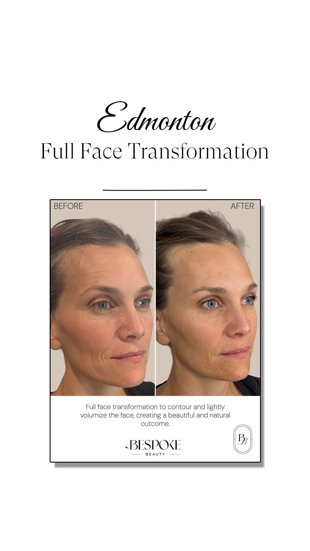 Edmonton Cosmetic Injections Enhance Natural Beauty