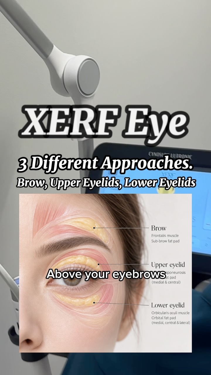 XERF Eye: Non-Surgical Eye Lifting Treatment