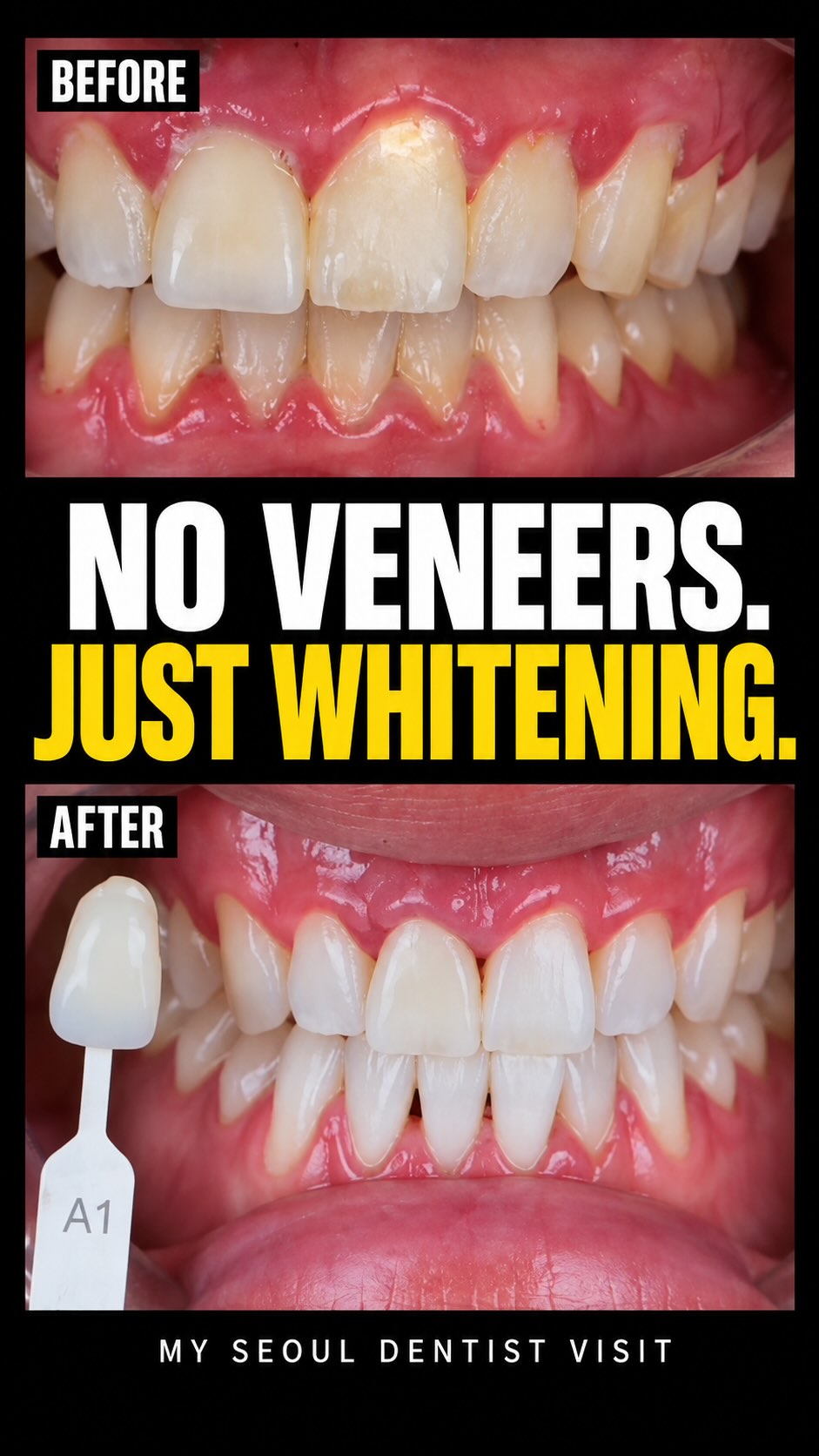 Gangnam Dental Clinic Offers Painless Teeth Whitening